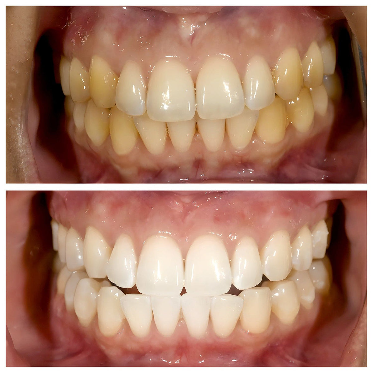 Dentifrice blanchissant à la niacinamide - TriBright